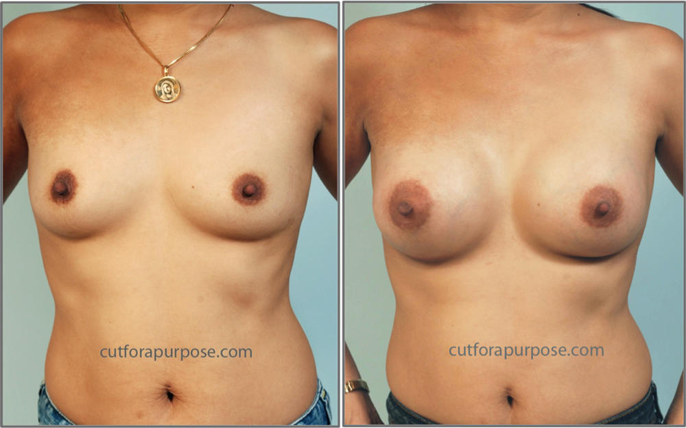 Dr. Jesusito S. Zubiri - Cosmetic Surgery Procedures: Breast Enlargement