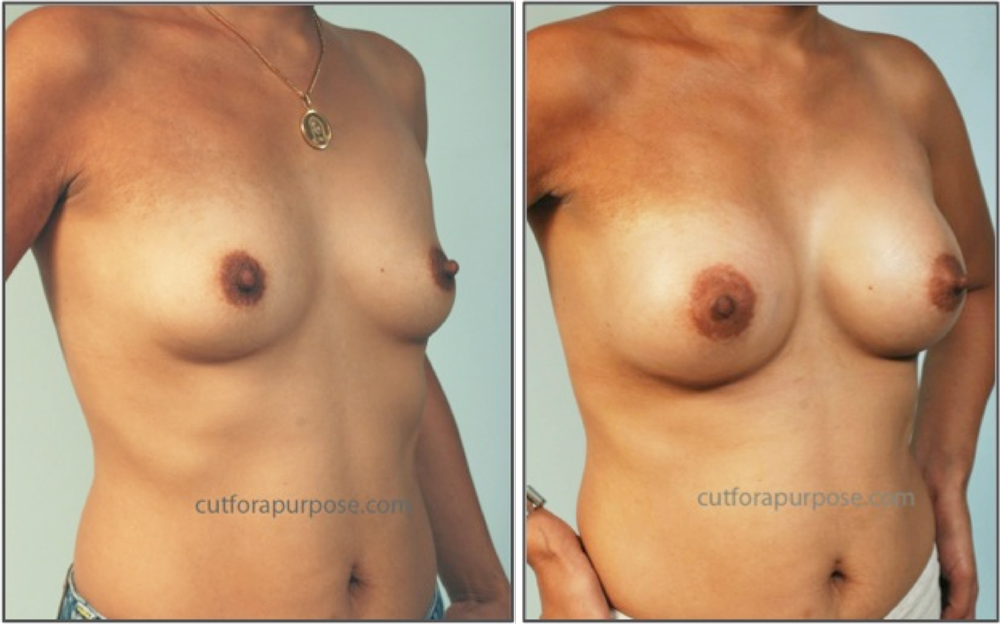 Dr. Jesusito S. Zubiri - Cosmetic Surgery Procedures: Breast Augmentation