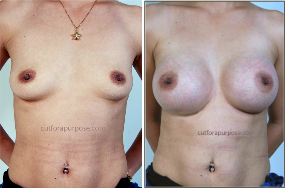 Dr. Jesusito S. Zubiri - Cosmetic Surgery Procedures: Breast Enlargement